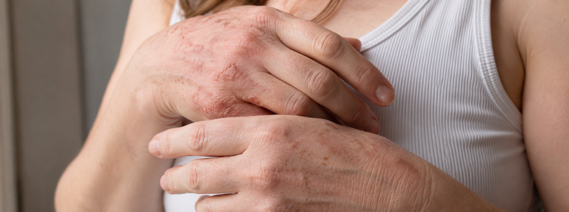 Dermatitis y signos de la edad