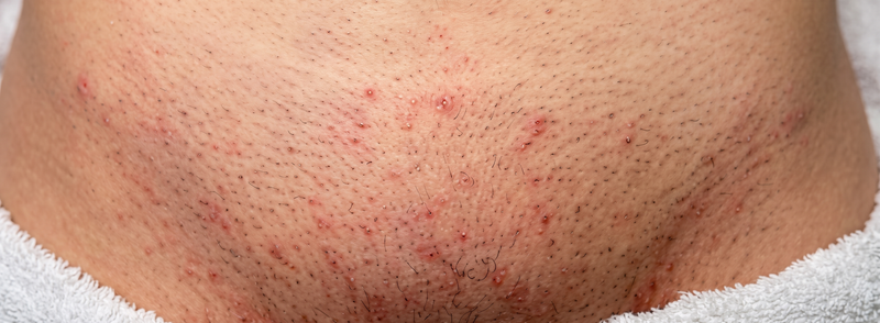 Foliculitis, irritación y vellos encarnados