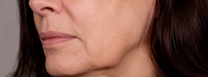 Perdida de firmeza y flacidez facial